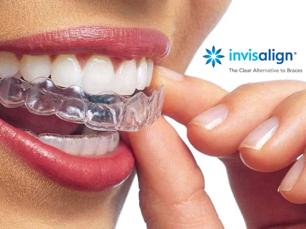 Mediante los tratamientos de ortodoncia corregimos la posición dental del paciente, mejorando la funcionalidad y la estética dental.