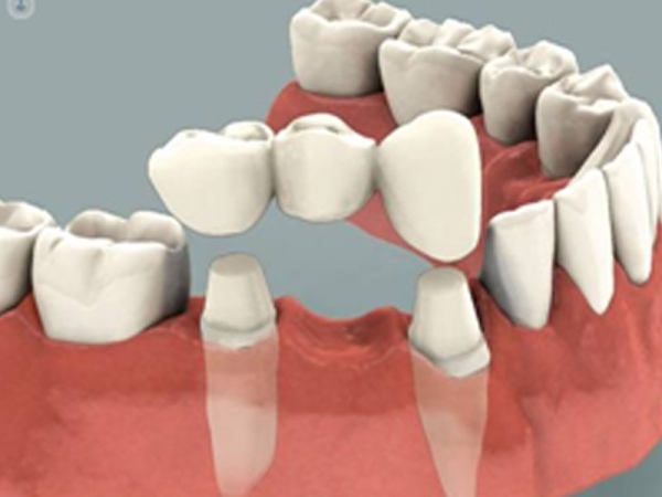 Las prótesis dentales, son aquellas estructuras fijas o removibles, que incorporamos en nuestro boca cuando tenemos ausencia de una o varias piezas dentales.