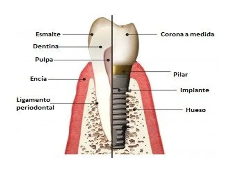 Implantología 